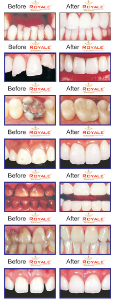 What Dental Problems can Royale Crown Solve?